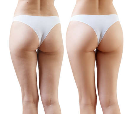 Female buttocks before and after cellulitis treatment.の写真素材
