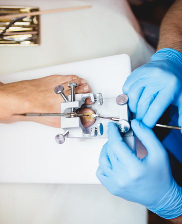 Toenail fungus treatment with foot laser at laser nail therapy clinic.の写真素材