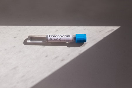 Blood sample tube positive with COVID-19. Coronovirus laboratory test
