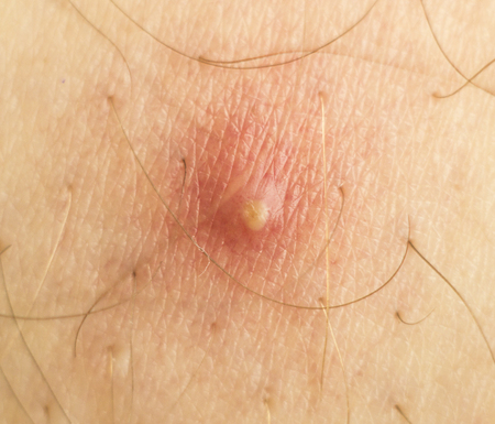 Pimple on the male foot, macro photography, blotchの写真素材