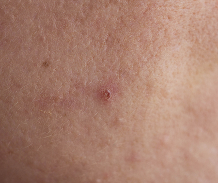 Red pimple on face macro, abscess and acne, whelkの写真素材