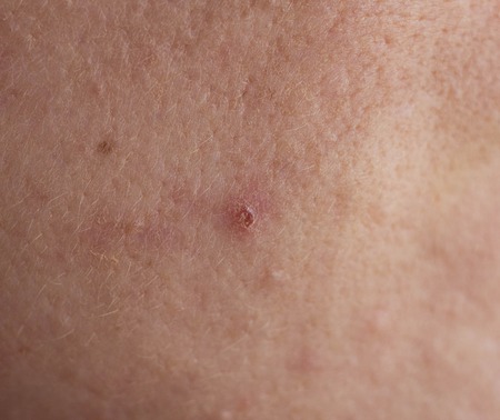 Red pimple on face macro, abscess and acne, whelkの写真素材