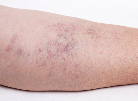 Vascular marks on the skin from varicose veins, vascular pattern on the skin, close-up, phlebeurysm, problem, white background, medicalの写真素材