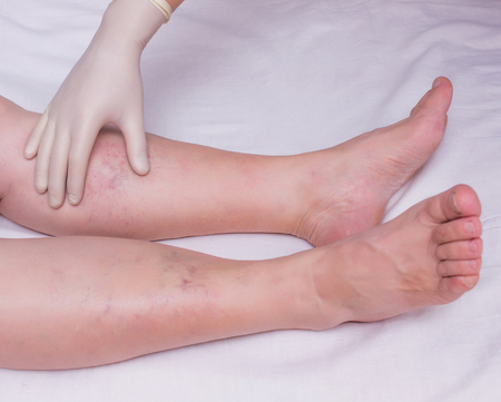 Doctor examines the patient's legs for the presence and degree of varicose veins in the legs, close-up, white background, phlebeurysm, womanの写真素材