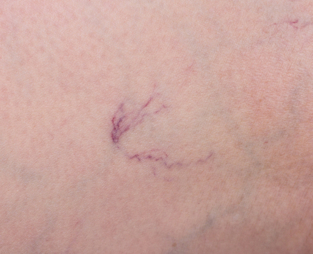 Footprint on the skin from vascular dilatation of veins, vascular pattern on human skin, close-up, phlebeurysm, capillaries, medical, problemの写真素材