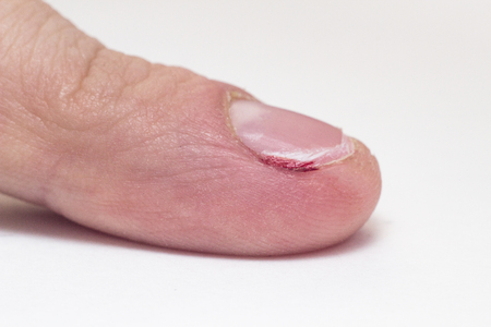 Finger with severed nail and burr, blood, macro, white background, manicure, barb copy spaceの写真素材