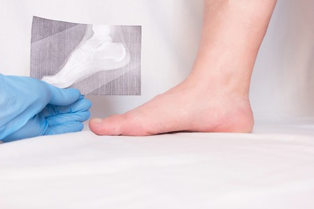 doctor holds x-ray in his hand and examines patient's leg with heel spur, close-up, plantar fasciitis, medical glovesの写真素材