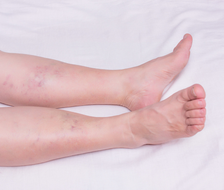 The legs of an elderly woman with varicose veins and thrombosis, white background, close-up, phlebeurysmの写真素材