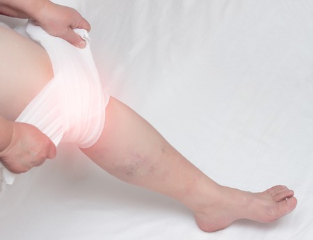 Treatment of arthritis of the knee and inflammation with a medical compress, tight bandage, close-up, copy space, orthopaedyの写真素材