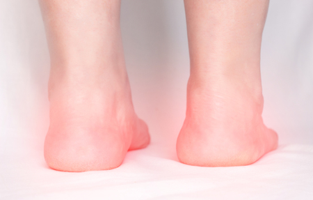 Legs of an adult woman on a white background with heel spurs, close-up, osteophyteの写真素材