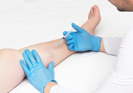 Doctor performs sclerotherapy for varicose veins on the legs, varicose vein treatment, copy spaceの写真素材