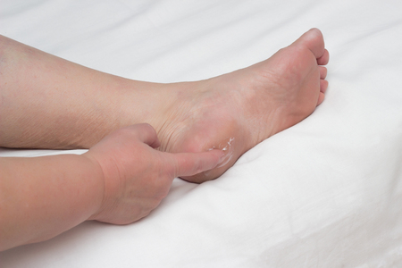Woman smears heel on her leg with healing ointment for the treatment of heel spurs, fascia, copy space, medicinal, close-up, calcification, myofascial syndromeの写真素材