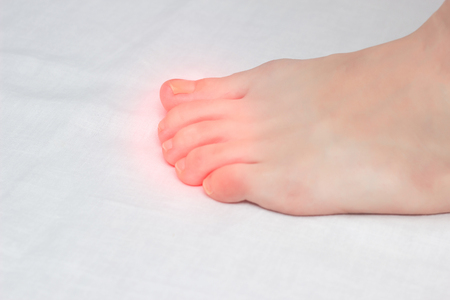 female foot with fungal infection on toes, close-up, white background, copy space, mycosis, painの写真素材