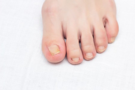 Female leg with ingrown toenail, onychocryptosis, close-up, white background, dermatologyの写真素材