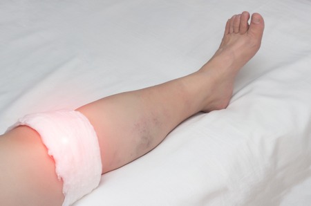 Medical compress on the knee joint in a woman, treatment of the knee with traditional medicine, close-up, inflammation, synovitisの写真素材