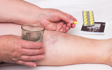 Old woman holding a glass of water and a pill for varicose veins on the background of the legs with varicose veins, close-up, thrombosis, phlebotomy, medicationの写真素材