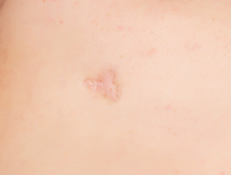 Large scar and scar on the patient's skin after removing an inflamed pimple, close-up, professional,...