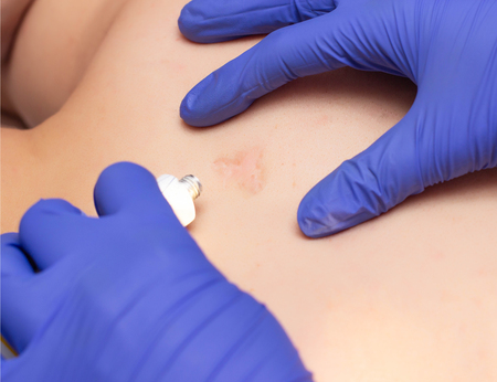 Doctor cosmetologist smears healing ointment scar and scar to the man on the back for healing,...