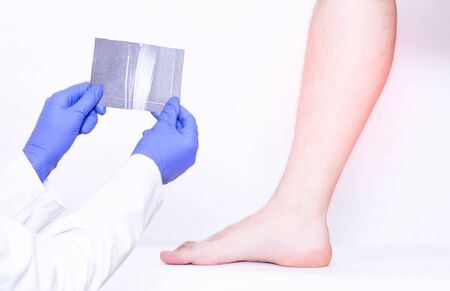 Doctor Traumatologist holds MRI snapshot of the calf ligaments of the male leg, sprain, medicalの写真素材