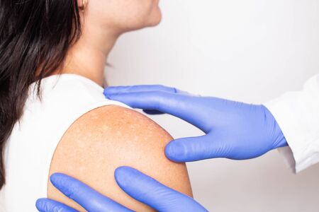 Doctor dermatologist conducts medical examination of problem skin on the patient's shoulder, pigment spots on the skin, melanin, healthcareの写真素材