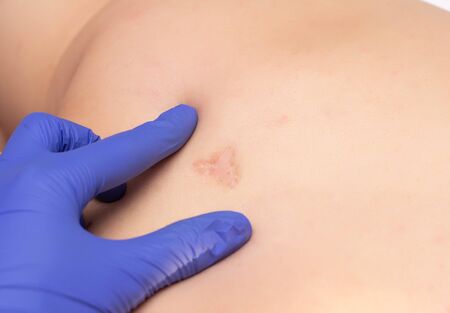 Doctor cosmetologist examines a scar and scar in a man on his back and skin, close-up, medicine, backgroundの写真素材