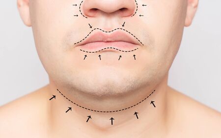 The face of a man marked with a marker before plastic surgery. Concept of facelift, rhinoplasty,...
