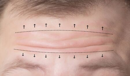 Close-up of male forehead with wrinkles and markers for surgery. Forehead plastic surgery concept, forehead wrinkle liftの写真素材