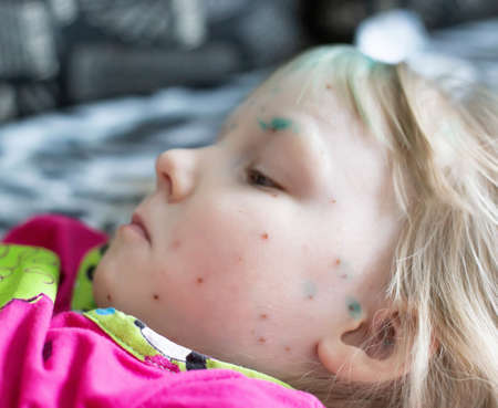 An infectious disease in a little girl, chickenpox on her face. Treatment of the herpes virus, chickenpox. healthcareの写真素材