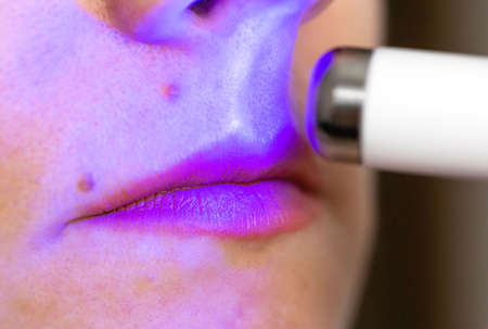 Girl treats inflamed red acne on the skin of the face with a laser cosmetic pen, cosmetic procedure. Dermatologistの写真素材