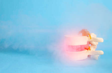 Intervertebral disc with a herniated spine on a blue background, smoke from low temperatures. The...