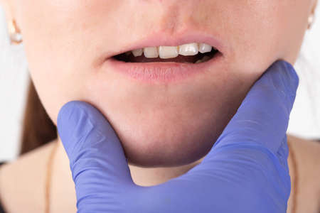 The doctor checks the jaw of a girl who has a malocclusion of her mouth and teeth, close-up
