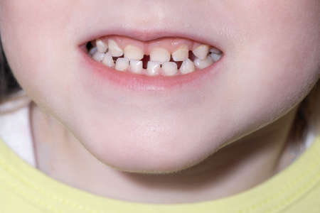 little girl with open mouth and baby teeth. The concept of proper care for the oral cavity and baby teeth in children, close-up. Dentistの写真素材