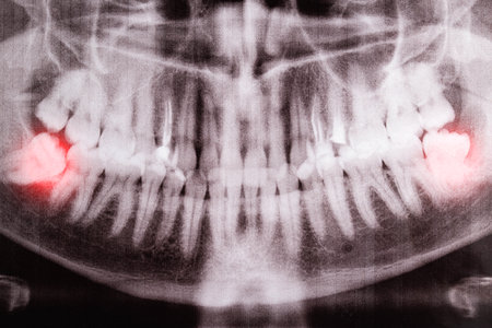 Impacted wisdom teeth on an X-ray picture with an inflamed cyst neoplasm. Removal of wisdom teeth in dentistryの写真素材