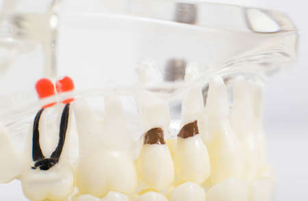 Dummy jaw with root canals, caries and pulpitis, macro