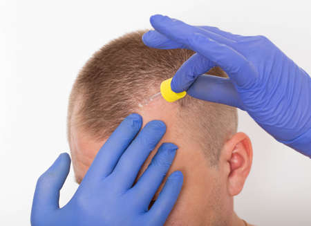 Healing oil for scalp hair restoration. Hair follicle restoration, close-up