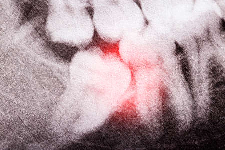 An unerupted semi-retired wisdom tooth on an x-ray picture, macro.