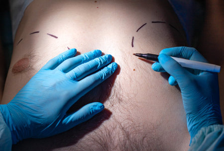 Doctor plastic surgeon makes marks with a felt-tip pen for plastic surgery to correct male breast, close-up.の写真素材