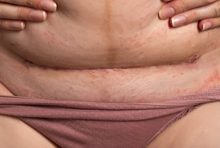 The seam on the abdomen of a woman after a caesarean section. Recovery of the female body after the...