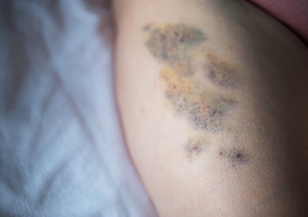 Bruises on the skin of the patient's leg after intramuscular injections of the drug. Treatment of seals and bruises after injections, close-upの写真素材