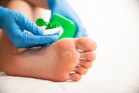 Treatment of a callus on the foot with a special solution after surgery to remove the callus and wart.の写真素材