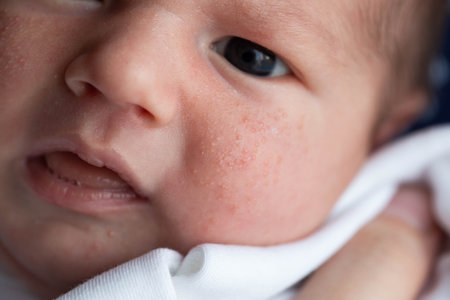 Allergic pimples in a newborn on the face. Pathogenesis, acne of newborns, close-upの写真素材
