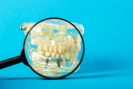 Medical mockup of a dental jaw under a magnifying glass on a blue background. The concept of dental pins for the installation of crowns and dental prosthetics in dentistry. Copy space for text, toothacheの写真素材