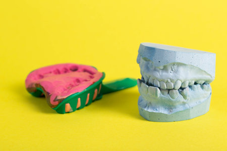 Dental spoon with alginate plastic mass for taking an impression of the dental jaw on a yellow background. Blue plaster dental jaw on a yellow background. Orthodontics in dentistry, manufacturing of dentures and dental crowns. Close-upの写真素材