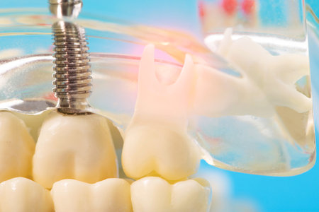 Medical model of a patient's dental jaw with pins in the gums and dental implants. Unerupted wisdom...
