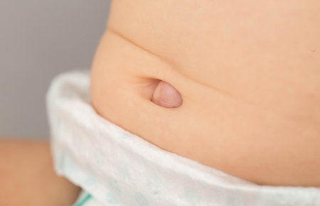 Umbilical hernia in a newborn baby on the stomach. Treatment of umbilical hernias in children without surgery, medicalの写真素材