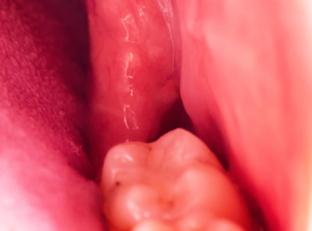 recess after complex impacted wisdom tooth extraction, traumatic healing. Dry socket, alveolitis. Copy space for textの写真素材