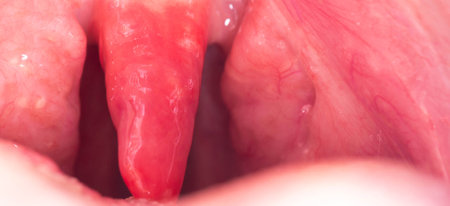 Long uvula with inflammation of infections and viruses. Treatment of uvulitis in children and adults. Sore throat, sore throat. Copy space for textの写真素材