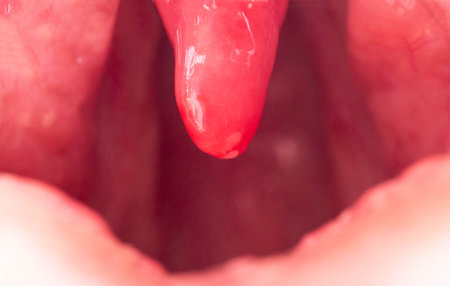 Inflammation of the uvula in the oral cavity due to infection and virus. Treatment of the disease is uvulitis. Red throat due to illness, macroの写真素材