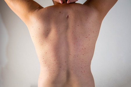 A man has a scar and red pimples on his skin. Inflammation of the sebaceous glands