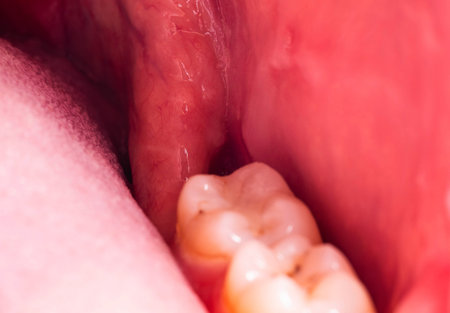 recess after complex impacted wisdom tooth extraction, traumatic healing. Dry socket, alveolitis. Copy space for textの写真素材